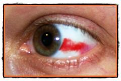 Leziunile oculare - simptome si prim ajutor